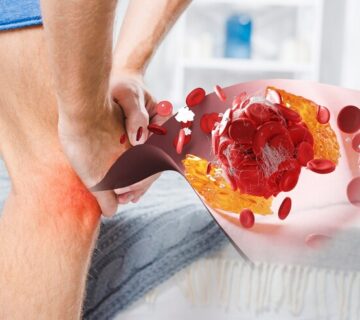 بیماری نقرس