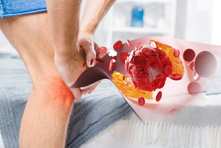 بیماری نقرس