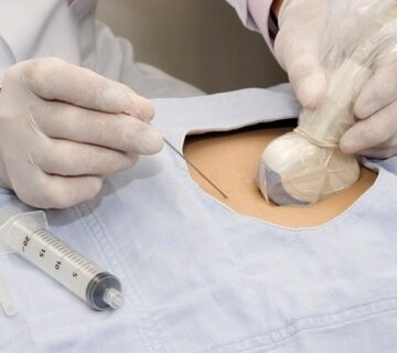 تست آمینوسنتز