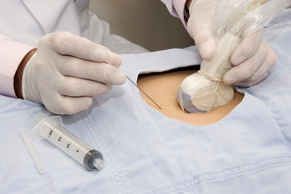 تست آمینوسنتز