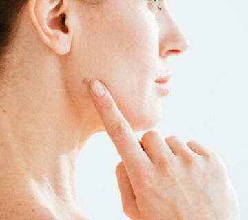 نمونه برداری خال