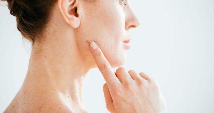 نمونه برداری خال