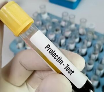 عکس آزمایش پرولاکتین