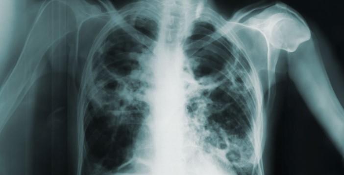 عکس بیماری سل