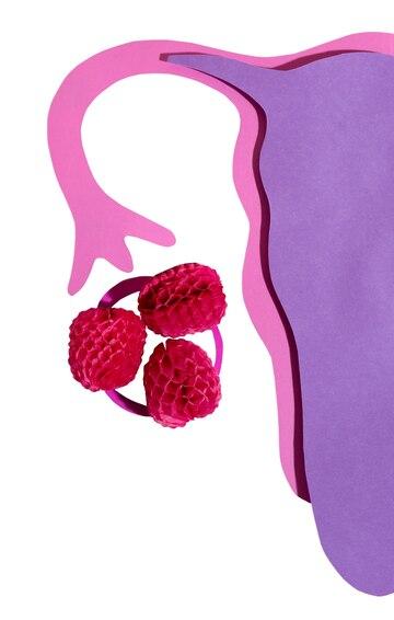 پلی کیست تخمدان