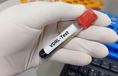 آزمایش VDRL