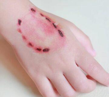 بیماری هاری