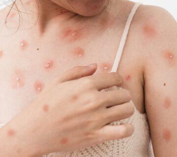 عکس آبله میمون