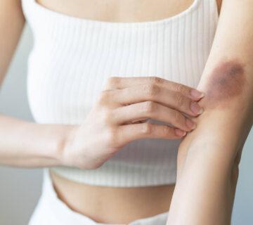 عکس کبودی خونگیری