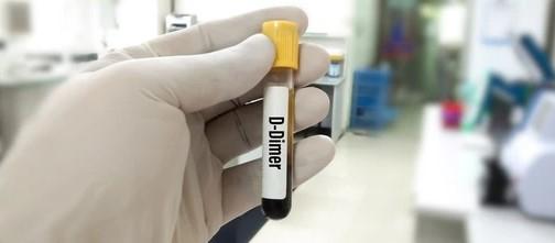 d-dimer test