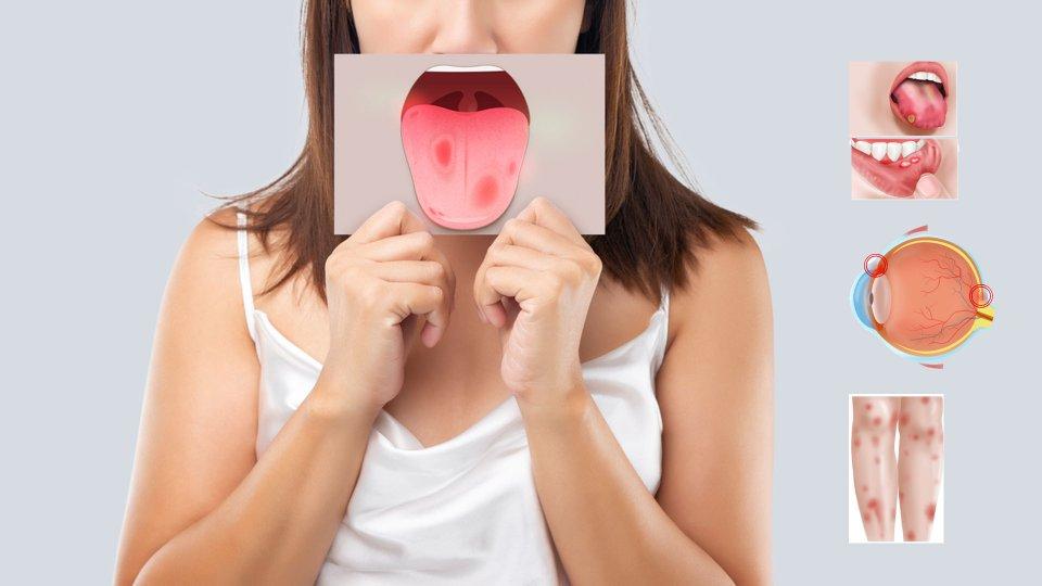 بیماری بهجت