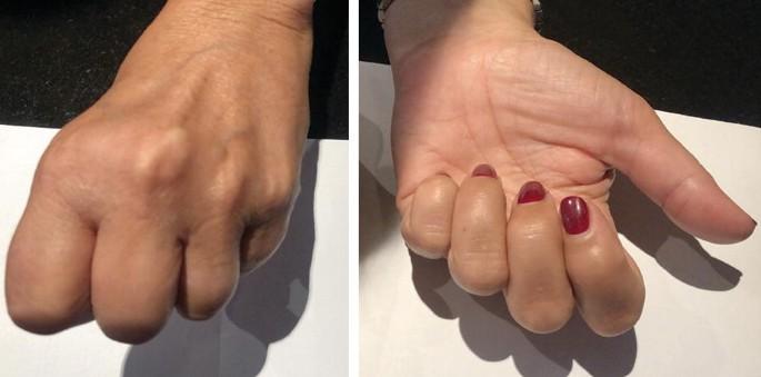 نمونه عکس بیماری هموکروماتوز