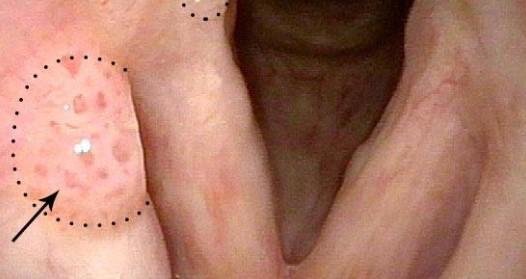 عکس HPV نوع 11