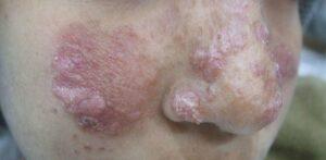 عکس بیماری سالک