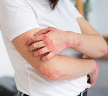 عکس بیماری لوپوس