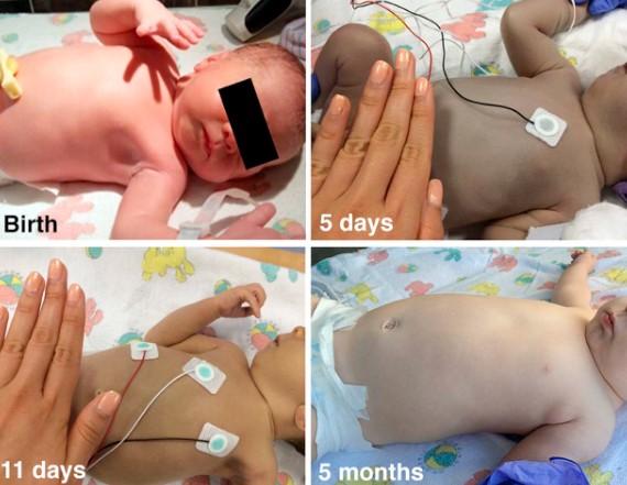 عکس سندروم کودک خاکستری