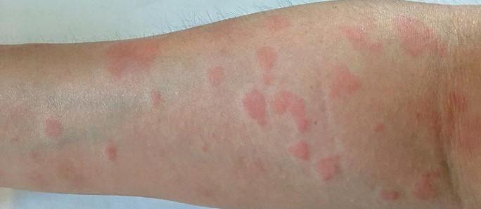 عکس لوپوس در دست