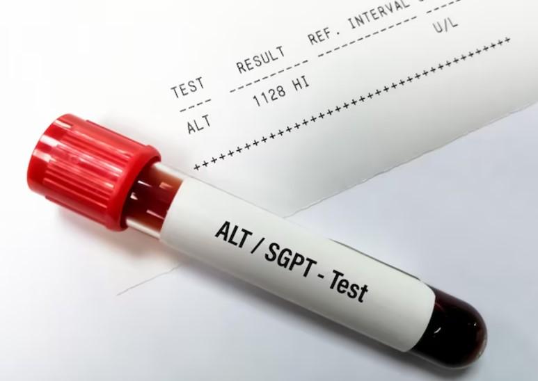 آزمایش ALT-SGPT