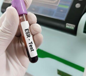 آزمایش ESR