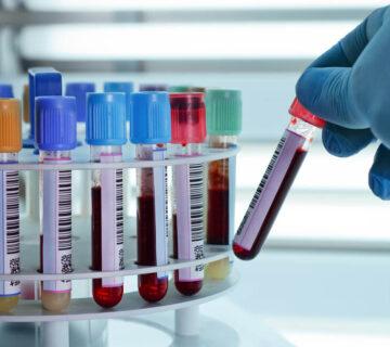 آزمایش نیتروژن اوره خون