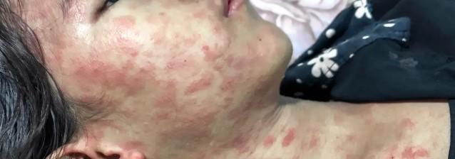 عکس ویروس چیکونگونیا