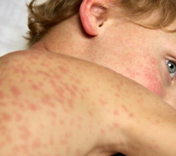 بیماری سرخک