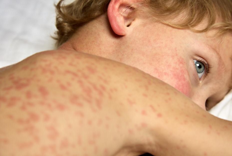 بیماری سرخک