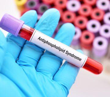 غربالگری سندرم آنتی‌ فسفولیپید