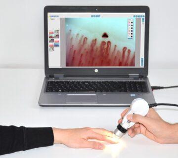 کاپیلاروسکوپی ناخن