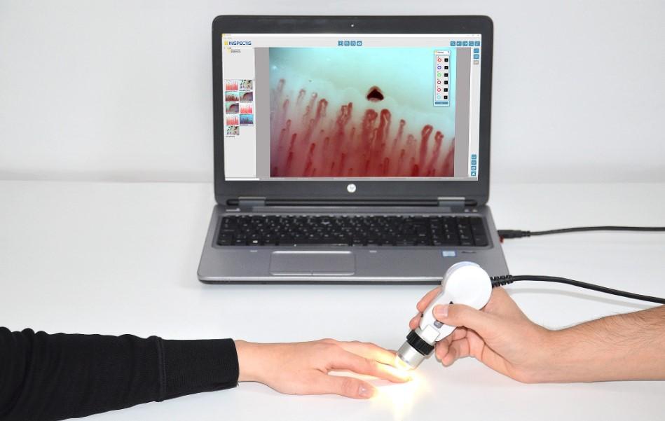 کاپیلاروسکوپی ناخن