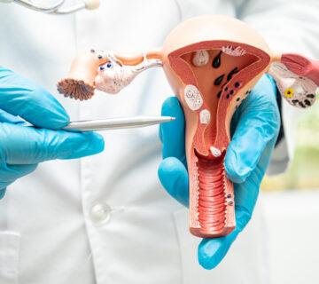 تست تشخیص سرطان تخمدان HE4