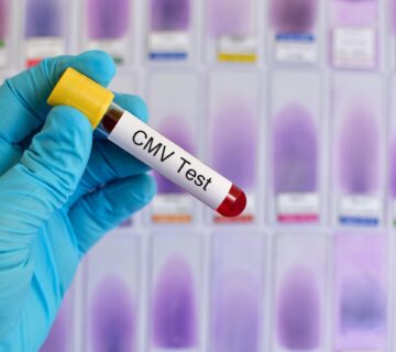 آزمایش CMV