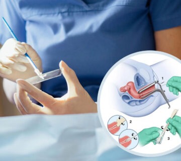 تست پاپ اسمیر ASCUS کولپوسکوپی