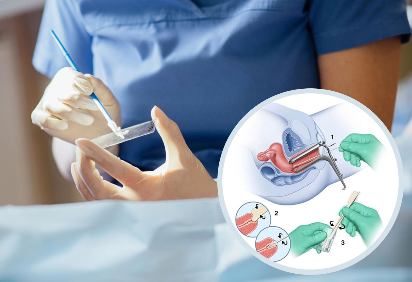 تست پاپ اسمیر ASCUS کولپوسکوپی