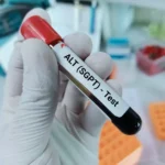تست های عملکرد کبد SGOT و SGPT