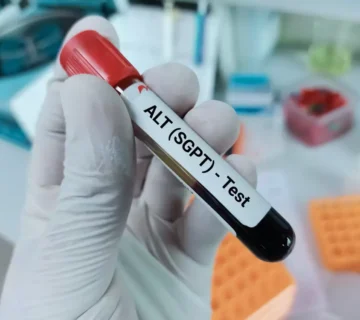تست های عملکرد کبد SGOT و SGPT