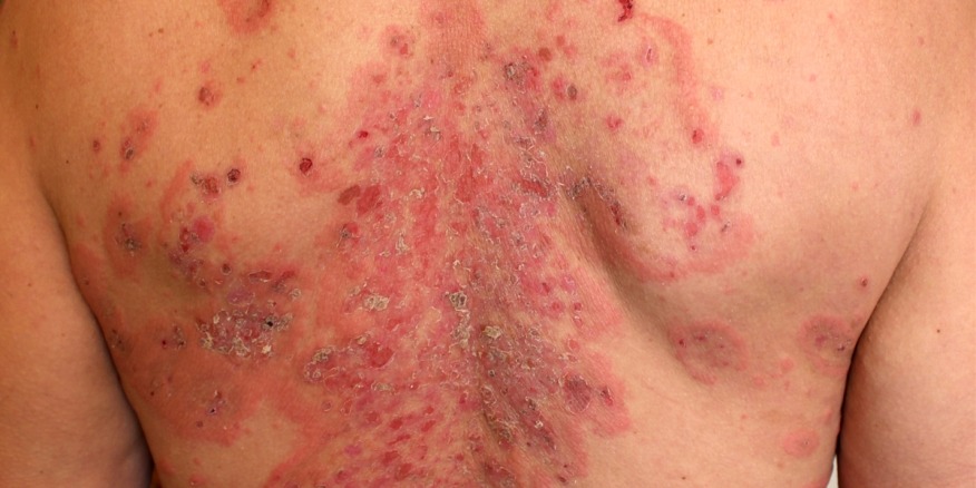 آزمایش Desmoglein 3 (DSG3)