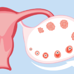 FSH در یائسگی زودرس