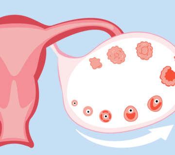 FSH در یائسگی زودرس