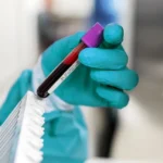 آزمایش هیدروکسی پروژسترون